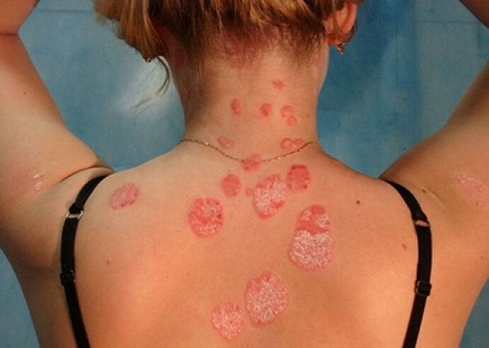 psoriasis on the neck and back