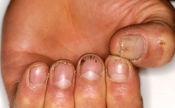 Bleeding under the nails with psoriasis