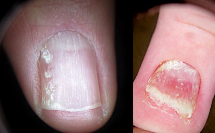 Crumbling nails with psoriasis