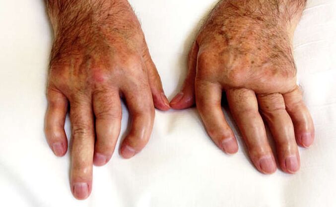 Mutilating arthritis in psoriasis