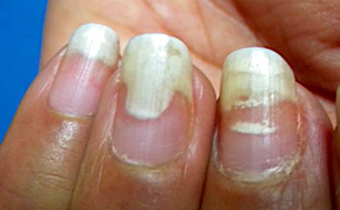 Onycholysis and leukonychia after the manicure