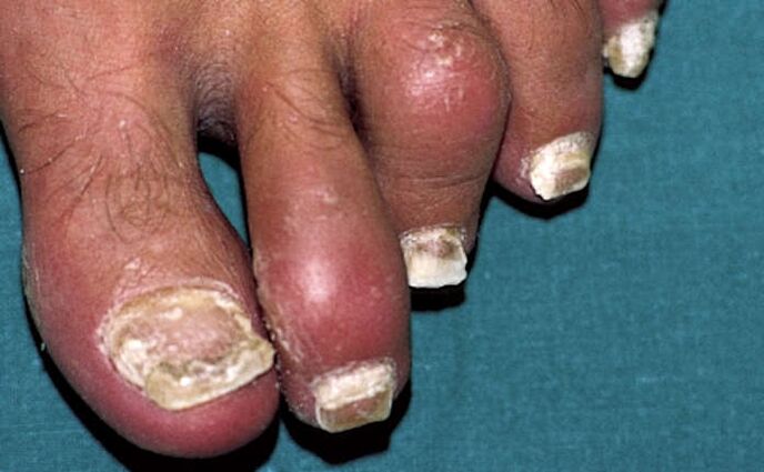 Psoriasis with nail involvement and joint inflammation (arthritis) of the toes