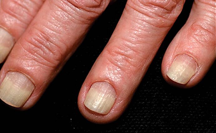Spread of onycholysis from the edge of the nail to the crease of the nail