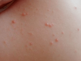 identify the symptom of rash psoriasis