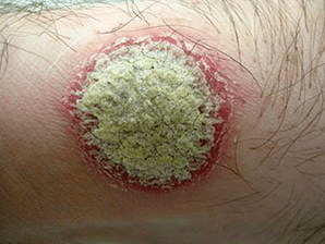 psoriasis symptom with coin rash