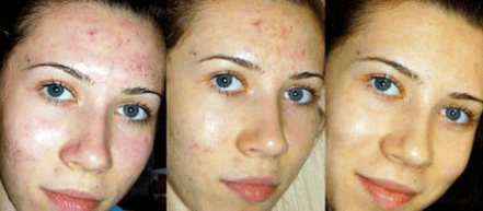 results of psoriasis treatment