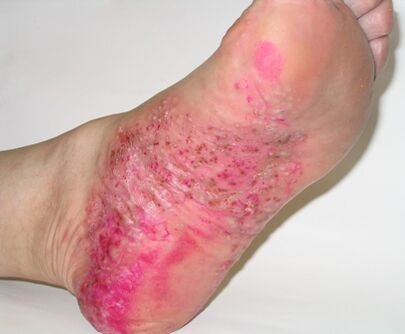 foot psoriasis
